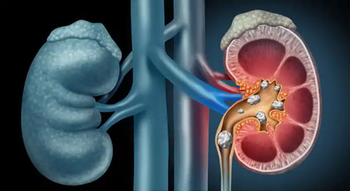 Kidney Stone Treatment Without Surgery