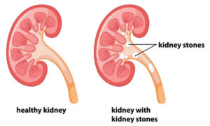 If you want to get rid of kidney stone, then consume these things?