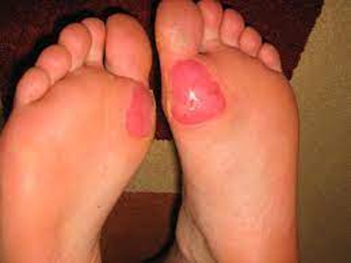 Home remedies for Foot blisters