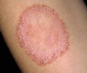 Ringworm Itching